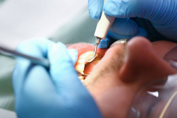 Best Emergency Root Canal Treatment in Fair Oaks Ranch, TX