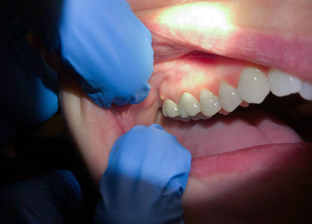 Best Emergency Dental Extractions in Fair Oaks Ranch, TX